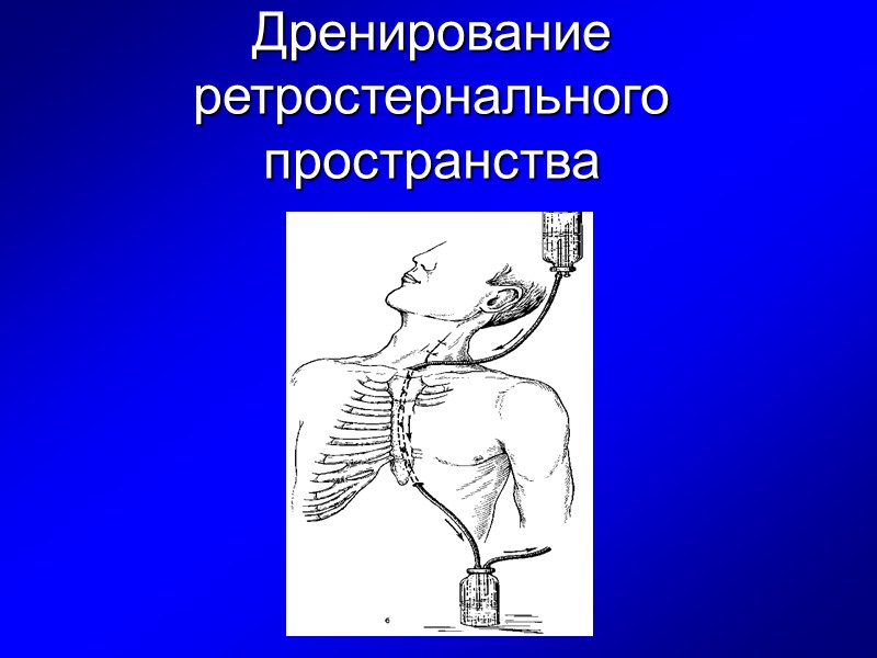 Дренирование ретростернального пространства